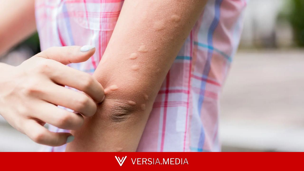 Los motivos por los que los mosquitos pican más a unas personas que a otras según un farmacéutico